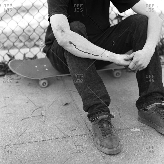 Skater with wounded arm sitting on skateboard