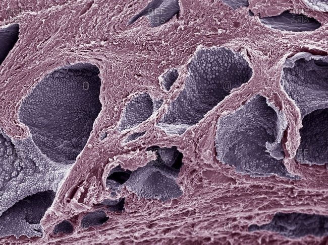 Magnification view of prostate cancer under a Color scanning electron micrograph