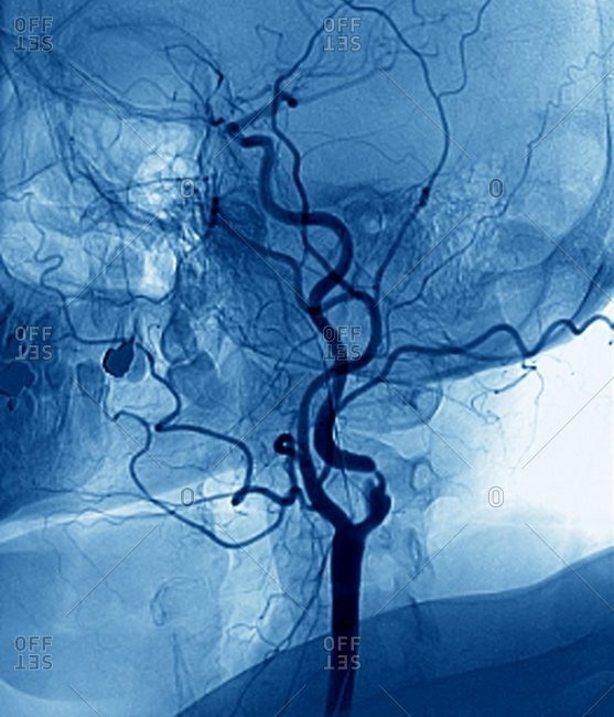 Color angiogram of the left carotid artery (black, center) in the neck of a 56 year old patient