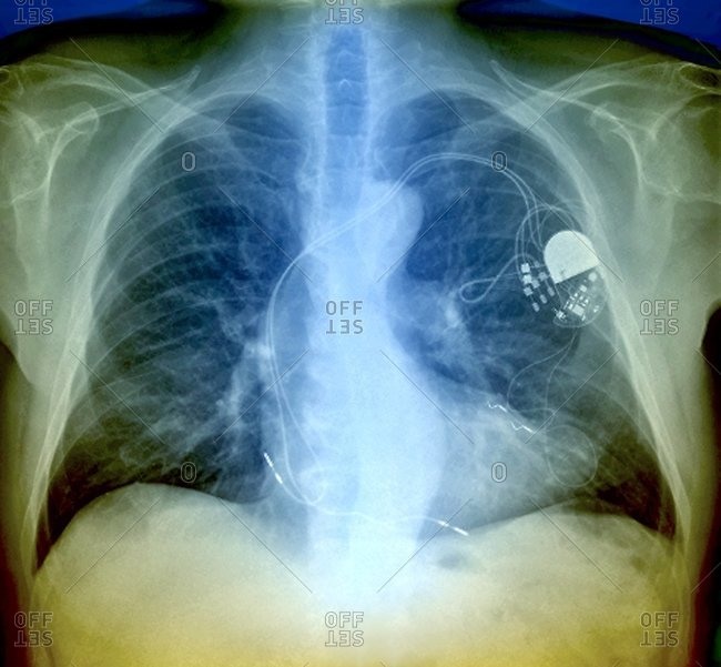Frontal X-ray of the chest of a 64-year-old patient with a heart pacemaker (upper right). The heart is at lower center.