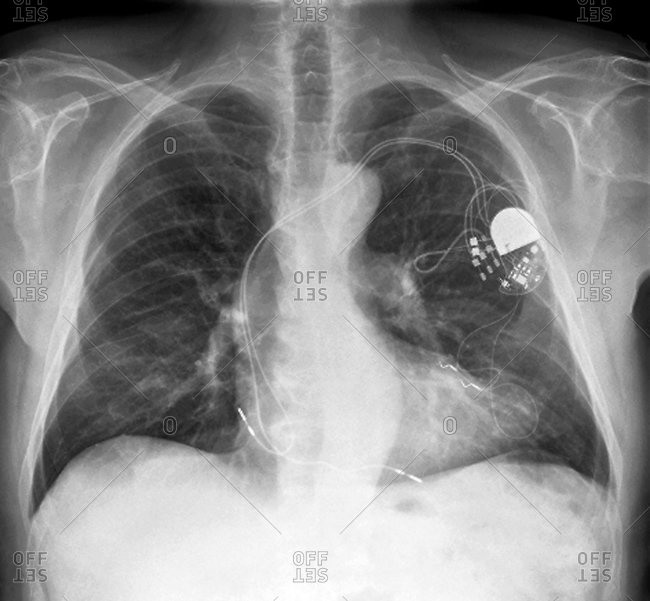 Frontal X-ray of the chest of a 64-year-old patient with a heart pacemaker (upper right). The heart is at lower center.
