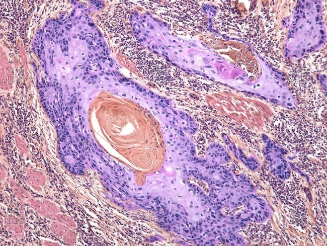 Light micrograph of a section through a squamous carcinoma of the skin.