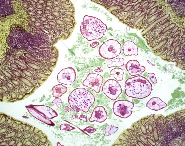 Light micrograph of a section through a stomach infected with parasitic nematode worms (pink). Food debris (green) is also seen.