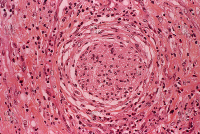 Light micrograph of a section of stomach tissue showing a lesion (center) caused by a gastric ulcer