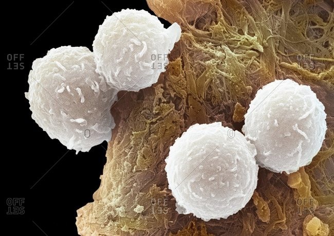 Leukemia blood cells under a Color scanning electron micrograph. B lymphocyte white blood cells (white).