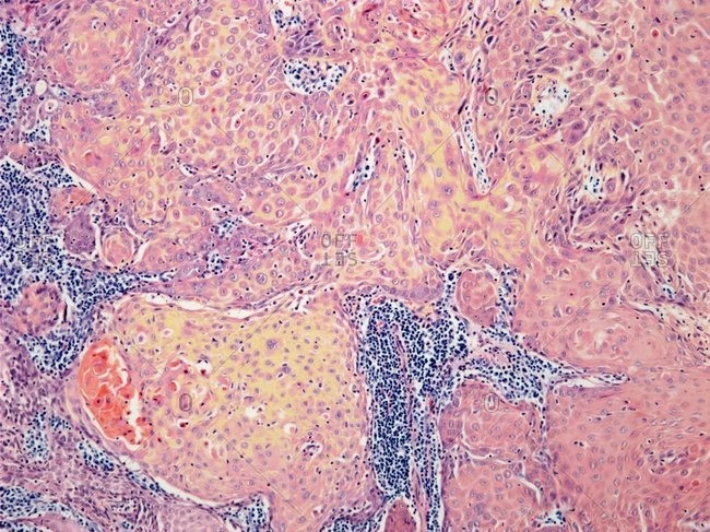 Light micrograph of a section through a squamous cell carcinoma of the tongue.