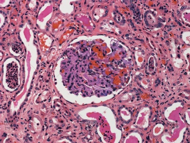 Light micrograph of a section through a kidney with acute nephritis (inflammation).