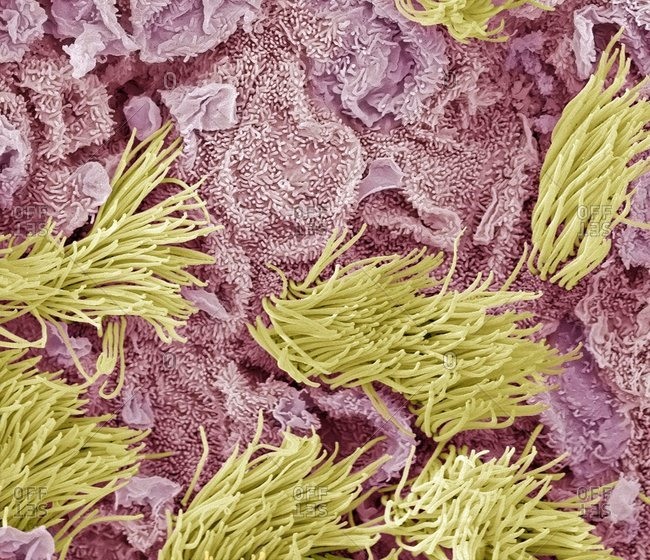 Uterine cancer under a Color scanning electron micrograph of adenocarcinoma (cancer) of the uterus.