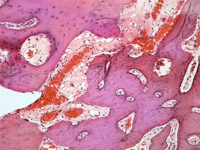 Light micrograph of a section through an osteoid osteoma, a rare benign (non-cancerous) tumor of bone tissue that is very painful.