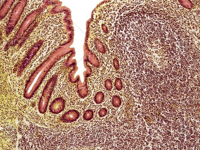 Appendicitis under a Color scanning electron micrograph.