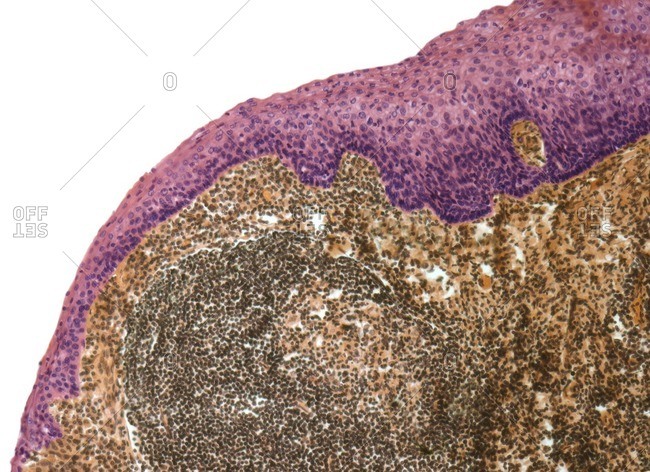 Light micrograph of a section through the surface of a tonsil showing the stratified squamous epithelium (pink) and underlying lymphoid tissue.