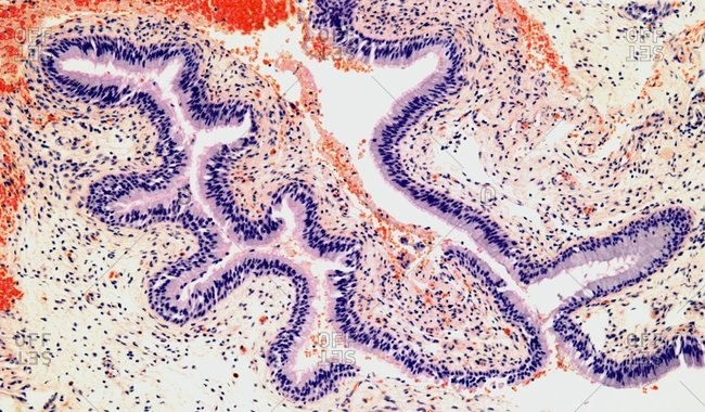Light micrograph of a section through a nasal polyp, a benign growth that arises from a mucous membrane.