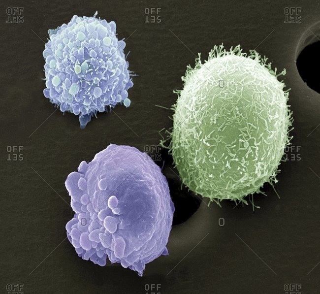 Magnification view of skin cancer cells under a Color scanning electron micrograph