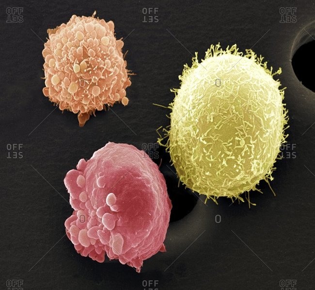 Magnification view of skin cancer cells under a Color scanning electron micrograph