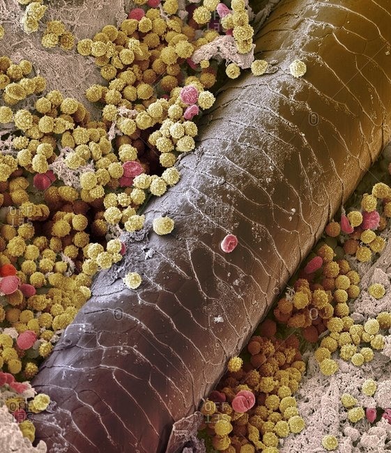 Pyoderma skin disease under a Color scanning electron micrograph.