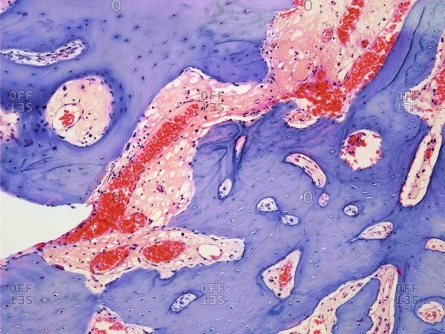 Light micrograph of a section through an osteoid osteoma, a rare benign (non-cancerous) tumor of bone tissue that is very painful.