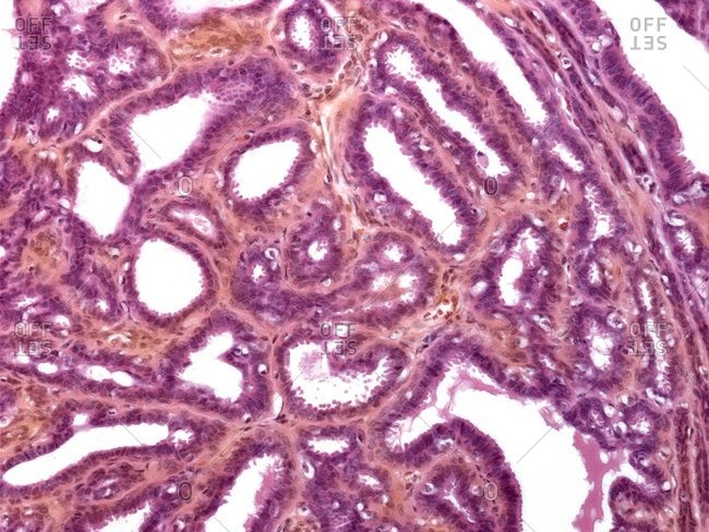 Light micrograph of a section through breast tissue showing mastitis (inflammation) of breast.