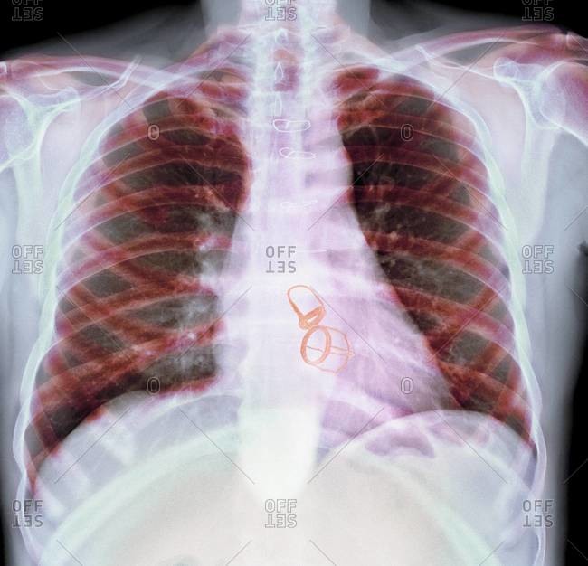 Chest x-ray of a patient showing their mitral and aortic heart valves replaced with prosthetic valves