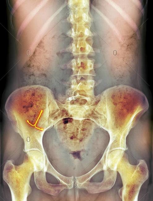 Colored x-ray of the lower abdomen of a female showing an IUD, ectopic intrauterine device, (T-shaped piece)