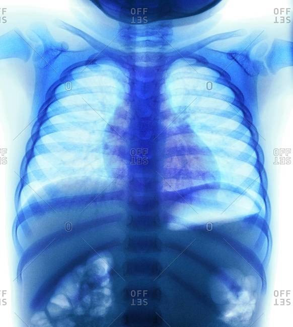 Colored x-ray showing coins in the oesophagus of a two year old girl