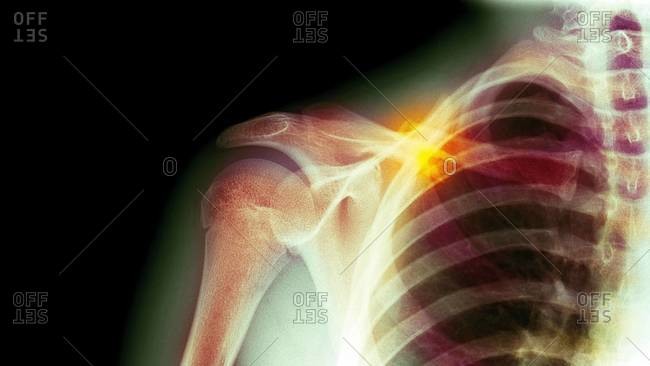 Colored x-ray of a 16 year old male with a fractured collar bone
