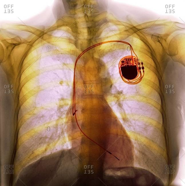 Colored x-ray of the chest of a patient with a dual chamber pacemaker