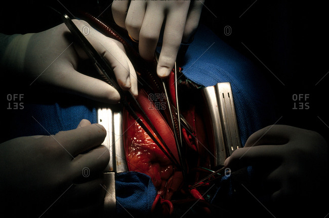 Heart surgery in operation