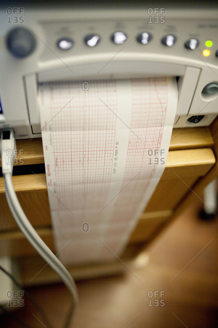 An electronic fetal monitor prints out a graph