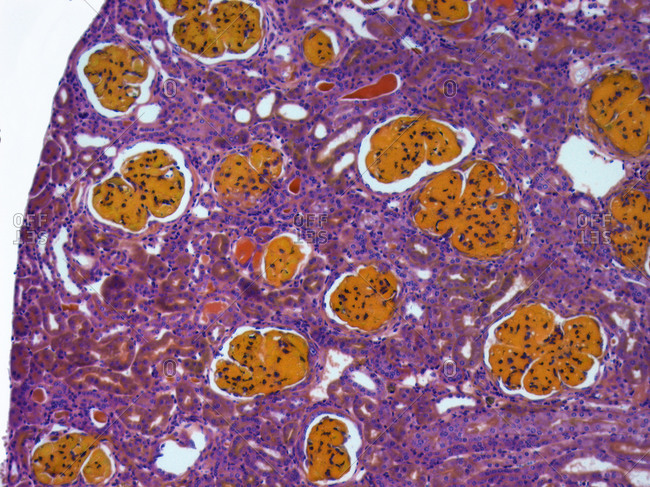 Light micrograph of tissue from a kidney in a case of glomerulonephritis most common causes of primary glomerular diseases in adults