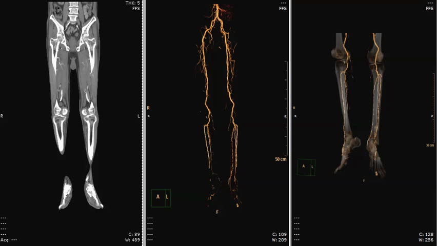 Computed Tomography Angiography Cta Of Stock Footage Video