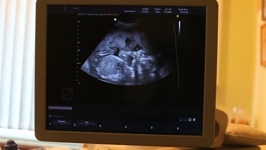 Ultrasound equipment - monitor