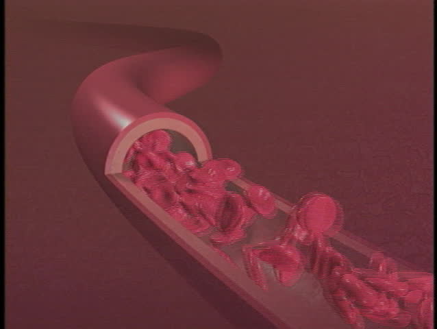 Clogged artery