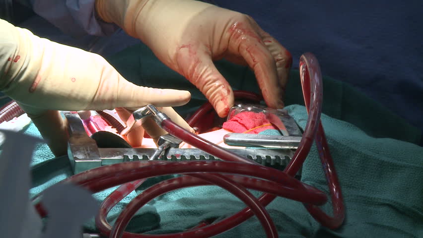 Blood flowing through heart bypass tubes