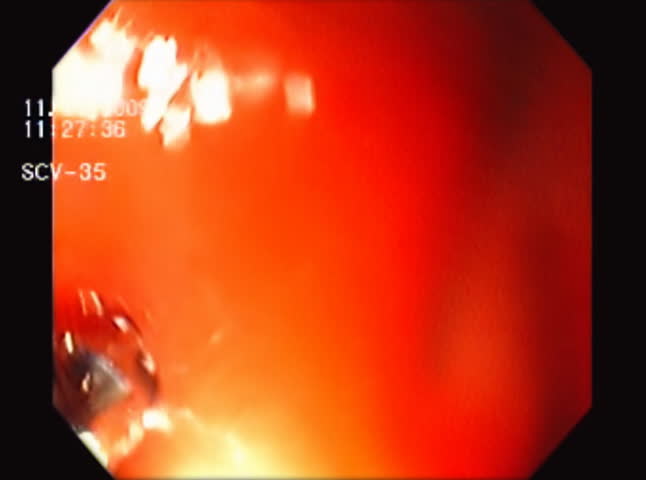 Duodenum Gut Biopsy. Gut biopsy near the duodenum area of the small intestine during an endoscopy procedure. Used in the diagnosis of anemia, bacterial infections and Celiac disease among others.