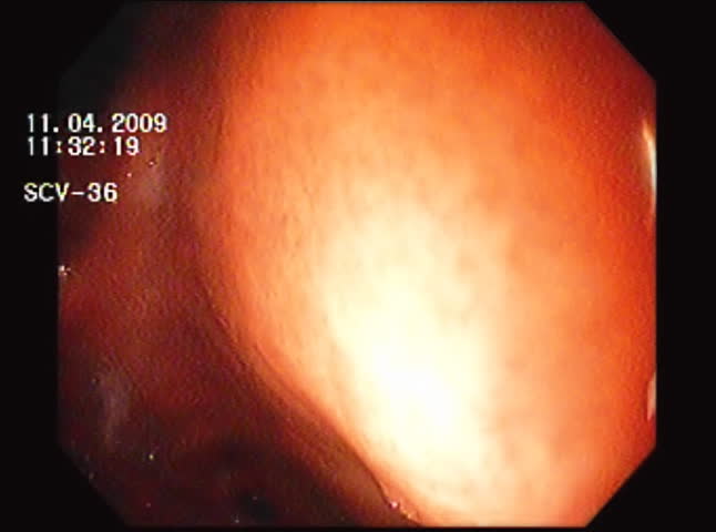 Lower Stomach Wall Biopsy. Gut biopsy near the duodenum area of the small intestine during an endoscopy procedure. Used in the diagnosis of anemia, bacterial infections and Celiac disease among others