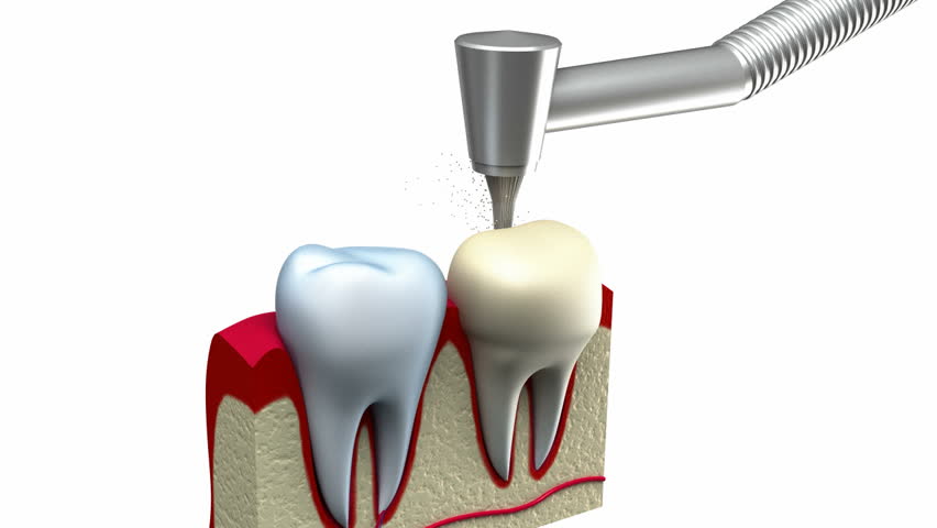 Dental crown installation process