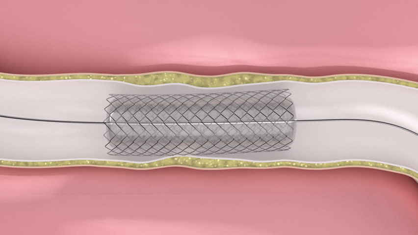 Coronary Angioplasty procedure - plague blocking blood flow