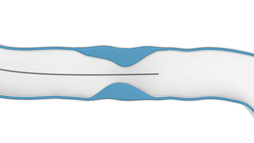 Coronary Angioplasty