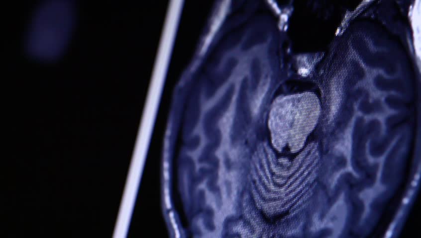 MRI scan on computer moniter