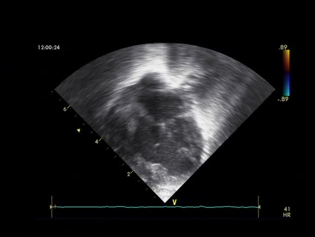 Ultrascan footage of human heart beats. Direct capture from ultrascan machine.