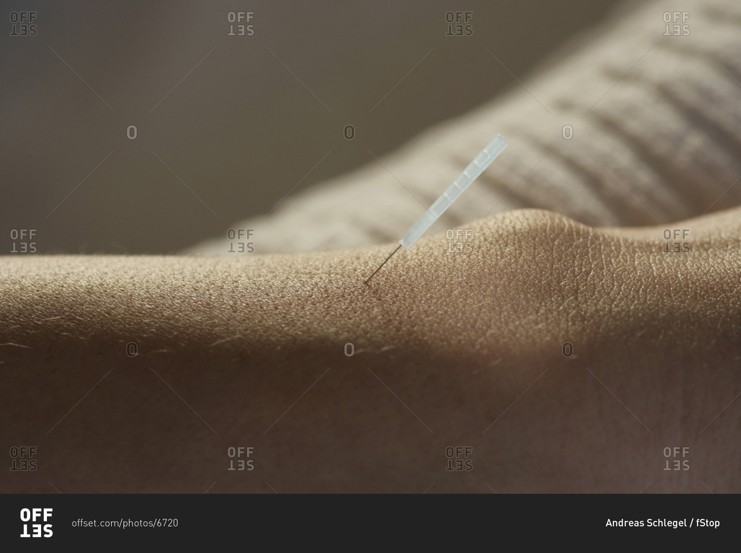 Young woman receiving acupuncture on wrist