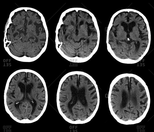 Series Of Magnified CT Scans Of An Axial Section Through The Head Of A ...