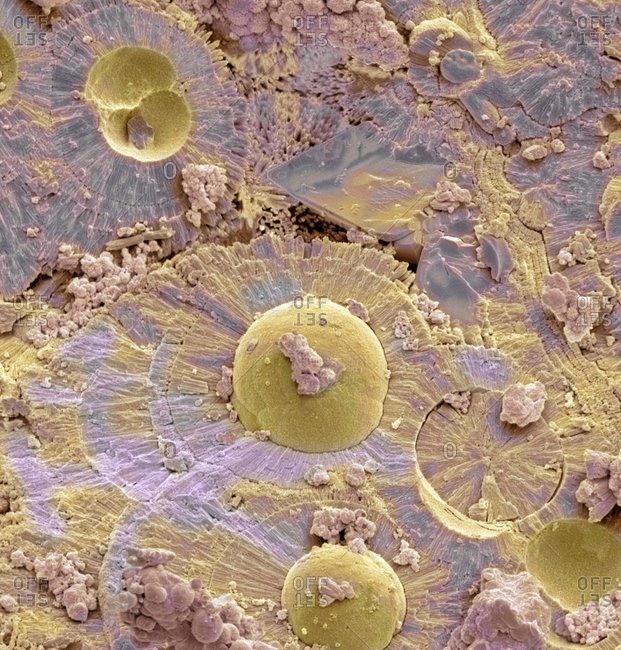 Color scanning electron micrograph of a fractured bladder stone.