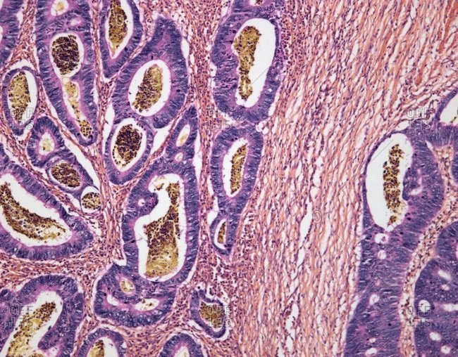 Light micrograph of an adenocarcinoma of the colon.
