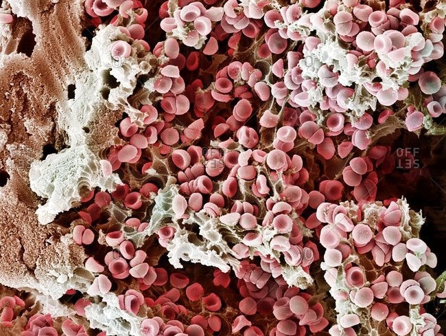 Color scanning electron micrograph of a freeze fracture through a blood vessel showing a blood clot (thrombus). The red blood cells (erythrocytes, red) are trapped in filaments of fibrin protein (gray).