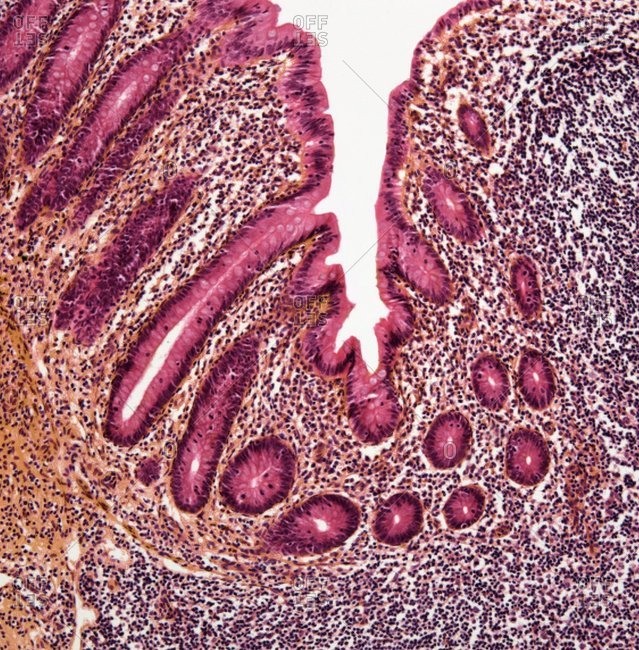 Light micrograph through a section of an appendix showing appendicitis.