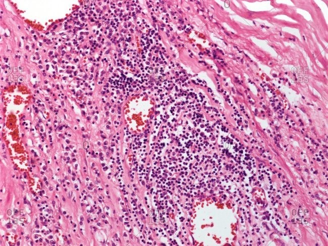 Cardiovascular syphilis under a light micrograph.