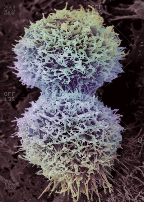 Color scanning electron micrograph of a dividing cervical cancer cell