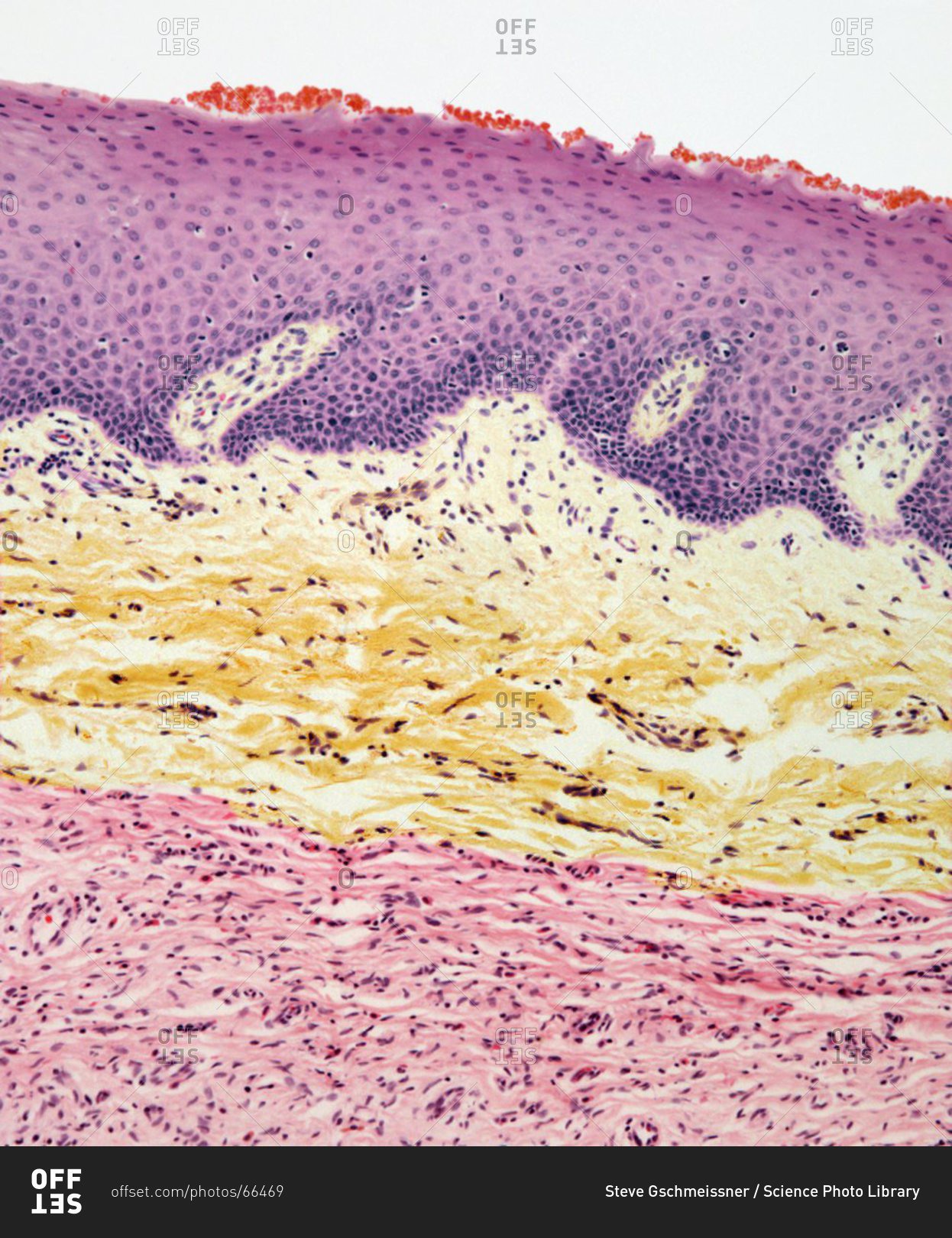 Light micrograph of a section through skin with a neurofibroma tumor ...