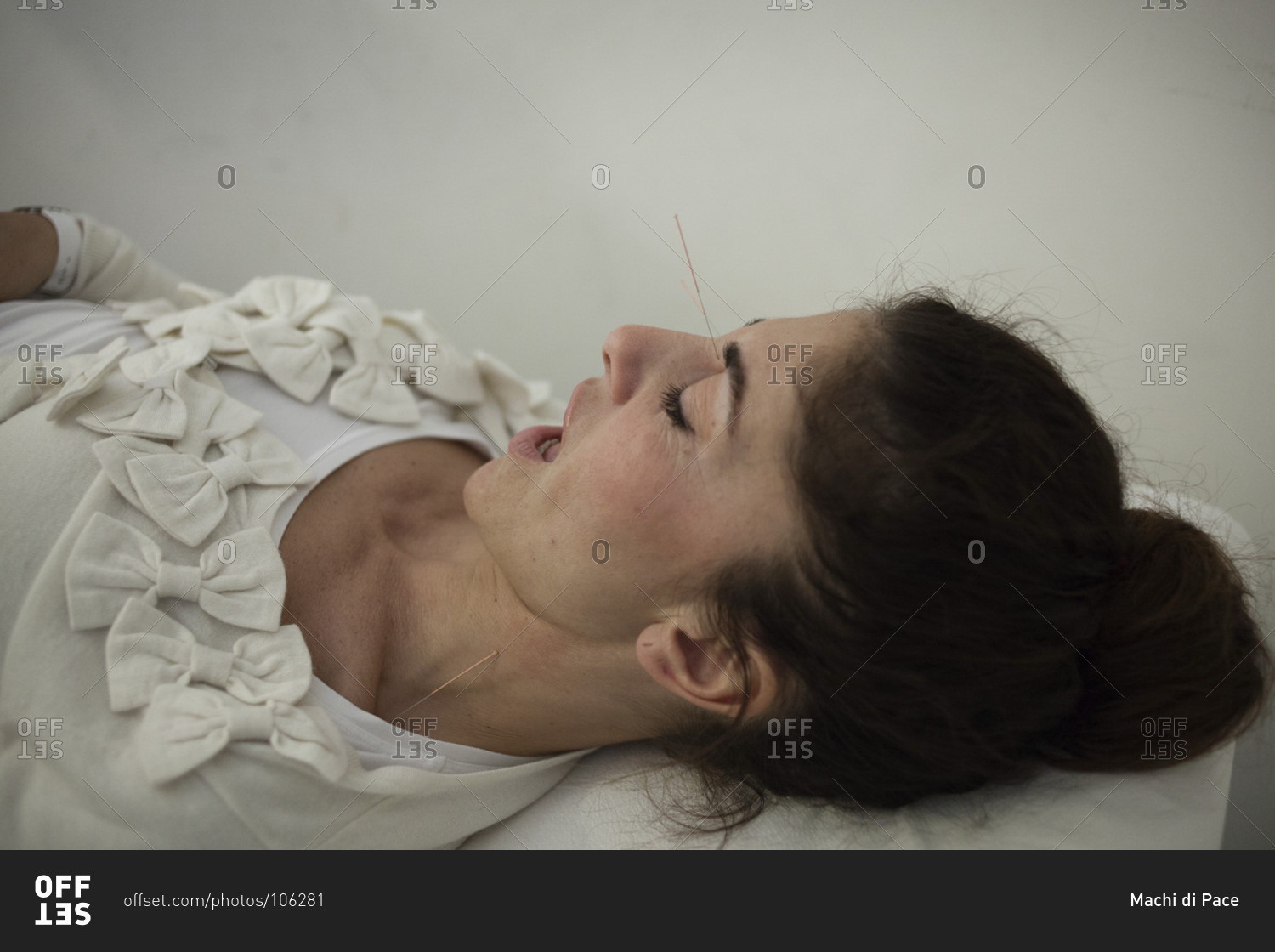 Woman having an acupuncture treatment
